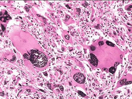 瘤巨细胞图片图片