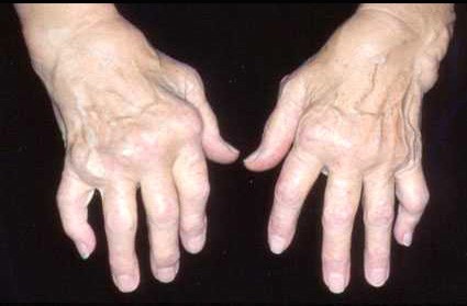 类风湿关节炎(如图)最常见的手部体征是 ( )
