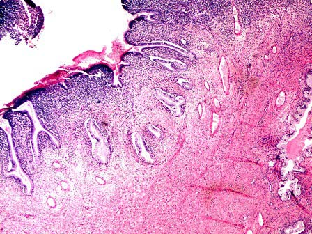 显微镜下大部分为肉芽组织,其表面被覆少许鳞状上皮