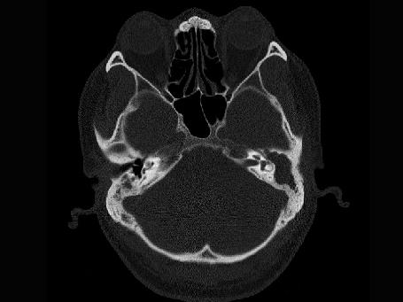 耳部ct图片
