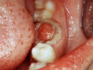 慢性增生性牙髓炎的特点是息肉  (    )