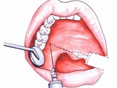 腭前神经腭大孔注射法麻醉时进针点是上颌第三或第二磨牙腭侧龈缘至腭