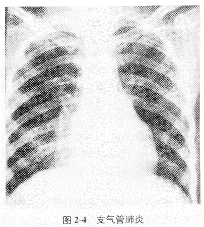 小叶性肺炎x片图片